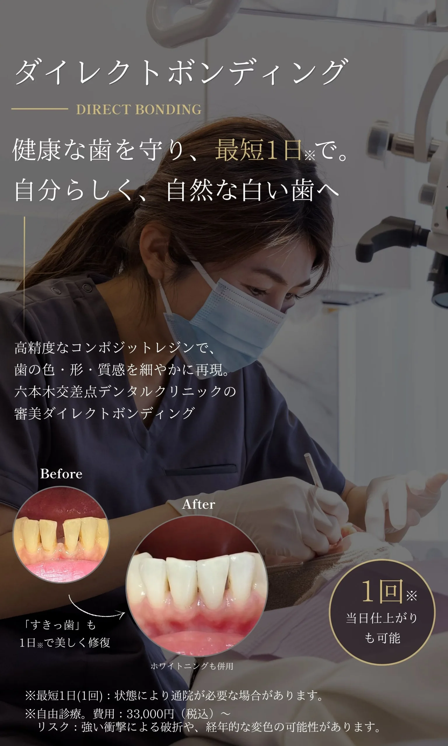 ダイレクトボンディングSP