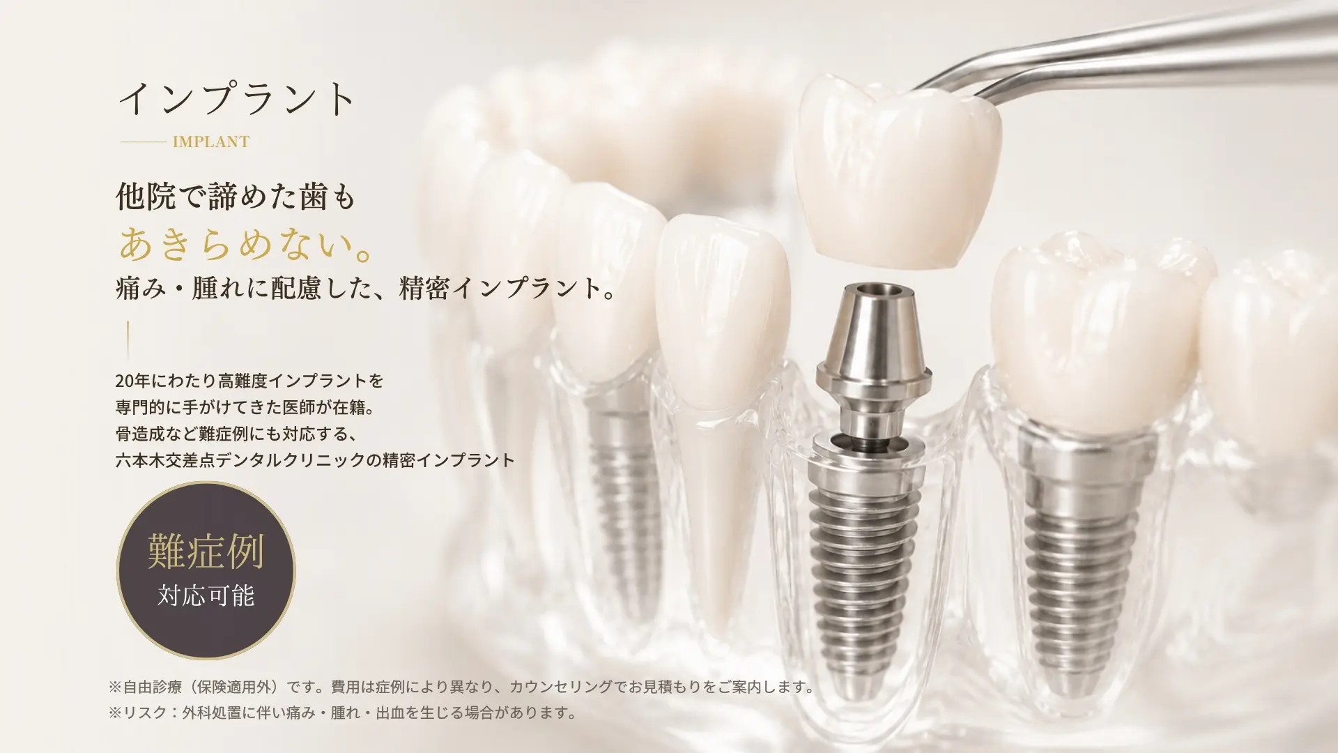 六本木交差点デンタルクリニックの精密インプラント治療